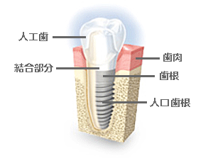 インプラント お子様連れも安心 高崎市岩押町の歯医者 柳沢歯科医院 です